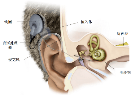 人工耳蜗和助听器区别图片