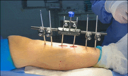 得了糖尿病足只能等截肢昆明骨科骨搬移让足部枯肢逢春