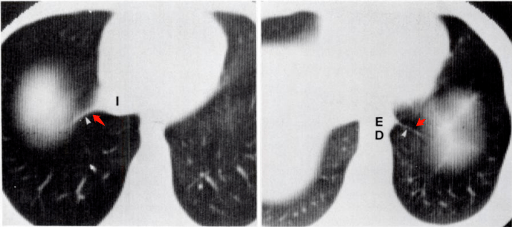 再把这个写成肺纤维条索影主任就要发火了