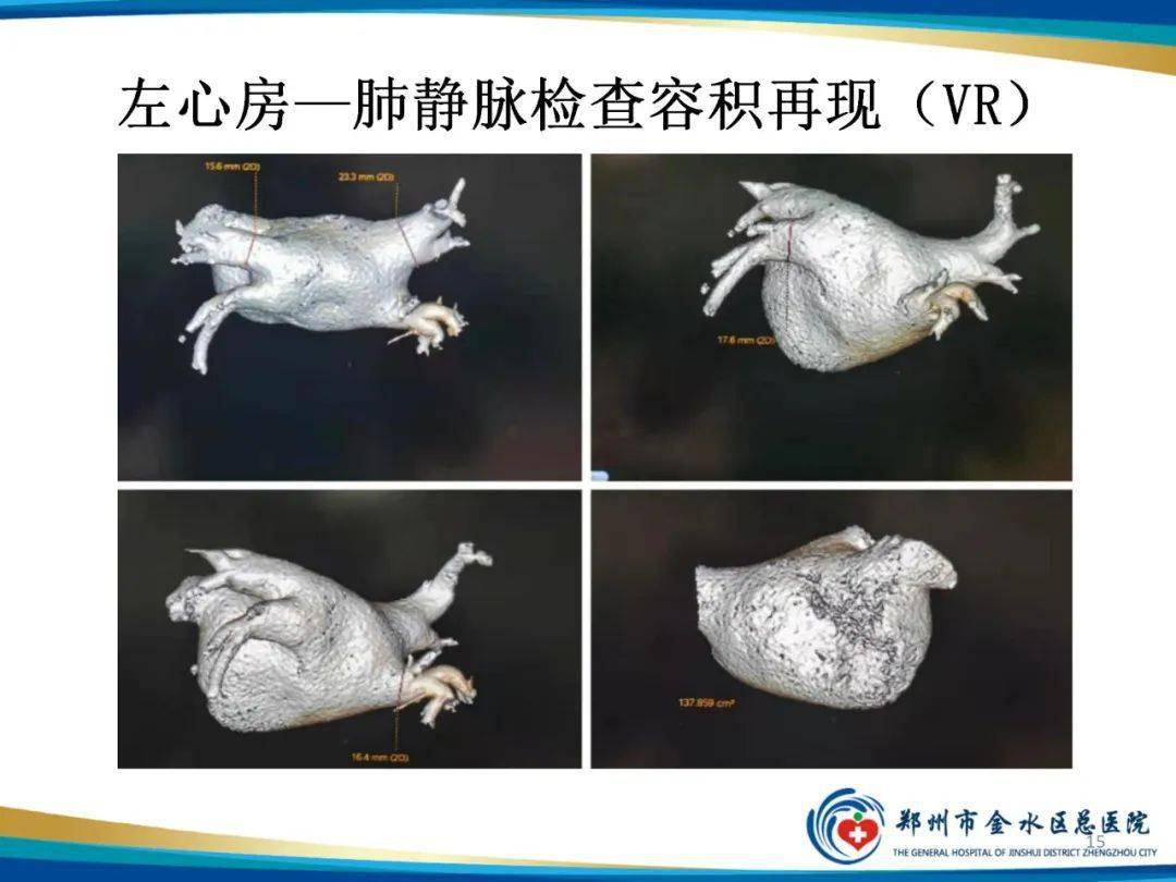 房颤术前的排查兵左心房肺静脉ctv检查