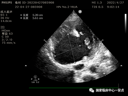 图2 假性室壁瘤较前增大为了赶在患者室壁瘤破裂前手术,北京安贞医院