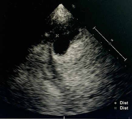 左心房附壁血栓图片图片