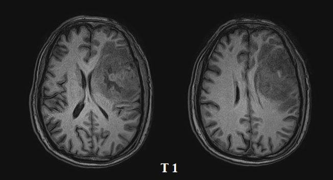爱见新生一例胶质母细胞瘤患者who4级术后辅助tmz联合肿瘤电场治疗总