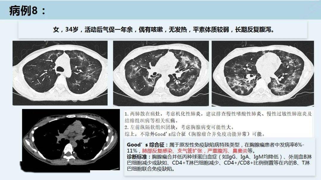 肺孢子菌肺炎的临床及影像特点