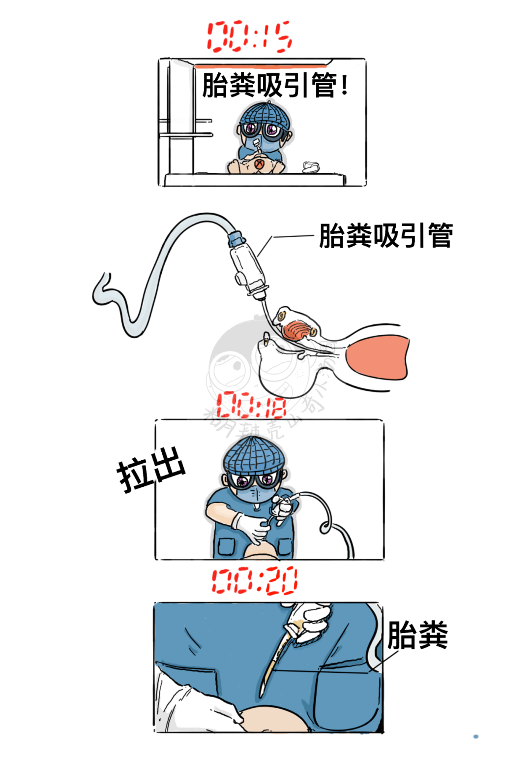 胎粪吸入综合征图片