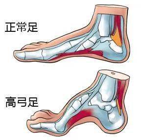 如何尽早发现和治疗足内翻?专家建议来了_马蹄_进行咨询_高弓