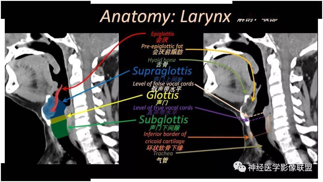 喉部解剖结构图解CT图片
