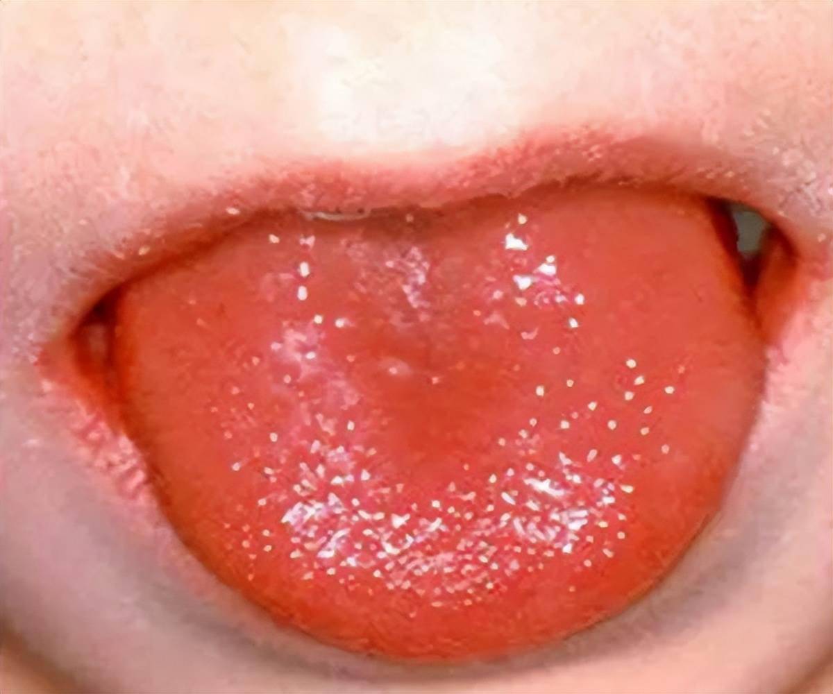 舌头上长红色的小疙瘩图片