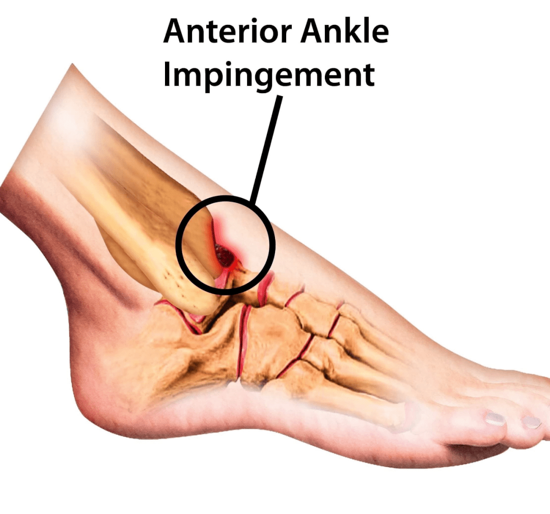 前距骨撞击这种情况表明当大脚趾支撑并且脚踝向下弯曲时,踝关节后面