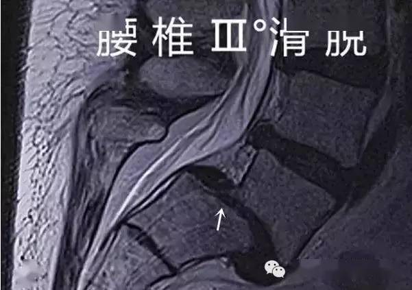 图解骶椎腰化腰椎骶化腰椎滑脱