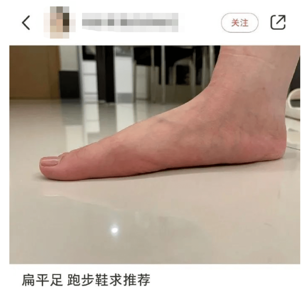 扁平足遗传图片