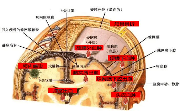 硬脑膜外血肿解剖图片