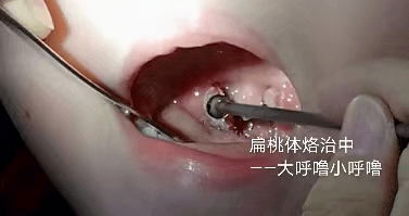 耳鼻喉医话什么是乳蛾患了乳蛾怎么治