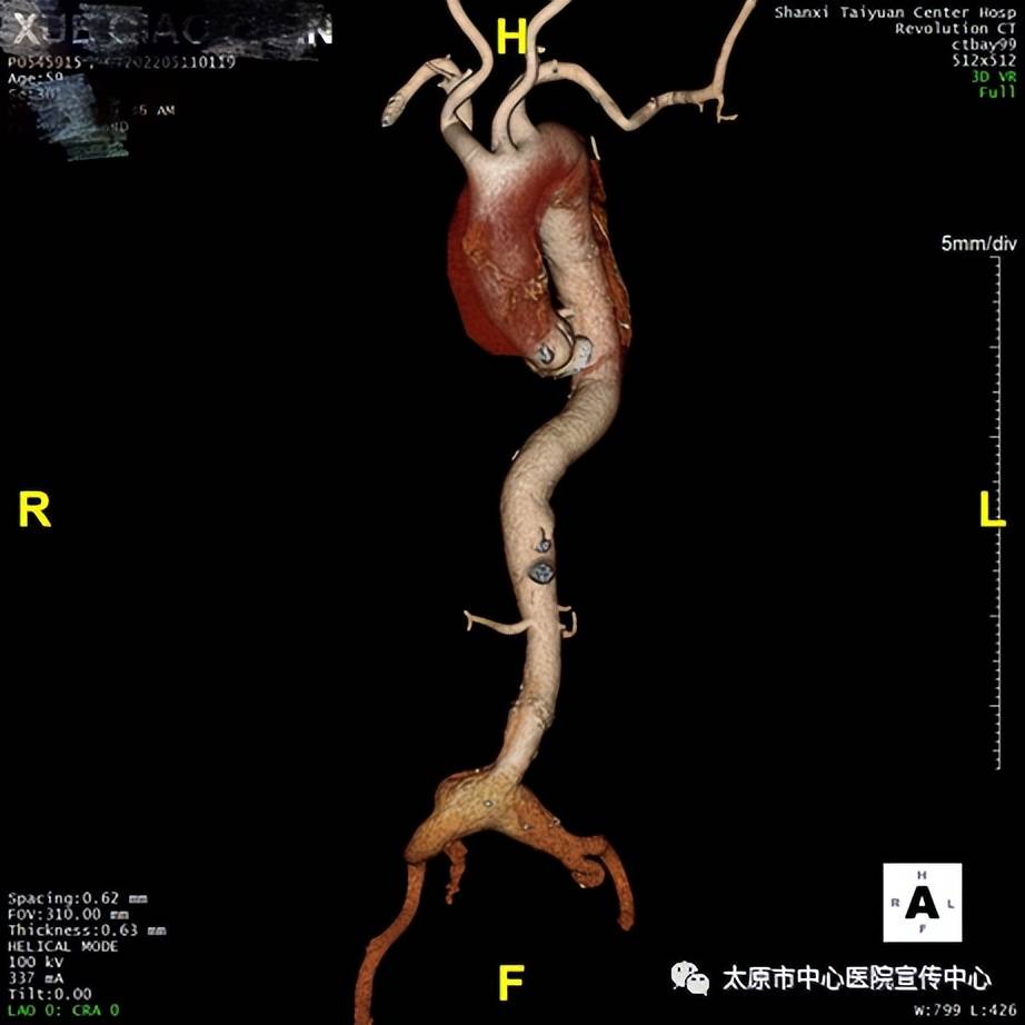 与时间角逐心胸大血管外科独立完成一例a型主动脉夹层的改良孙氏手术