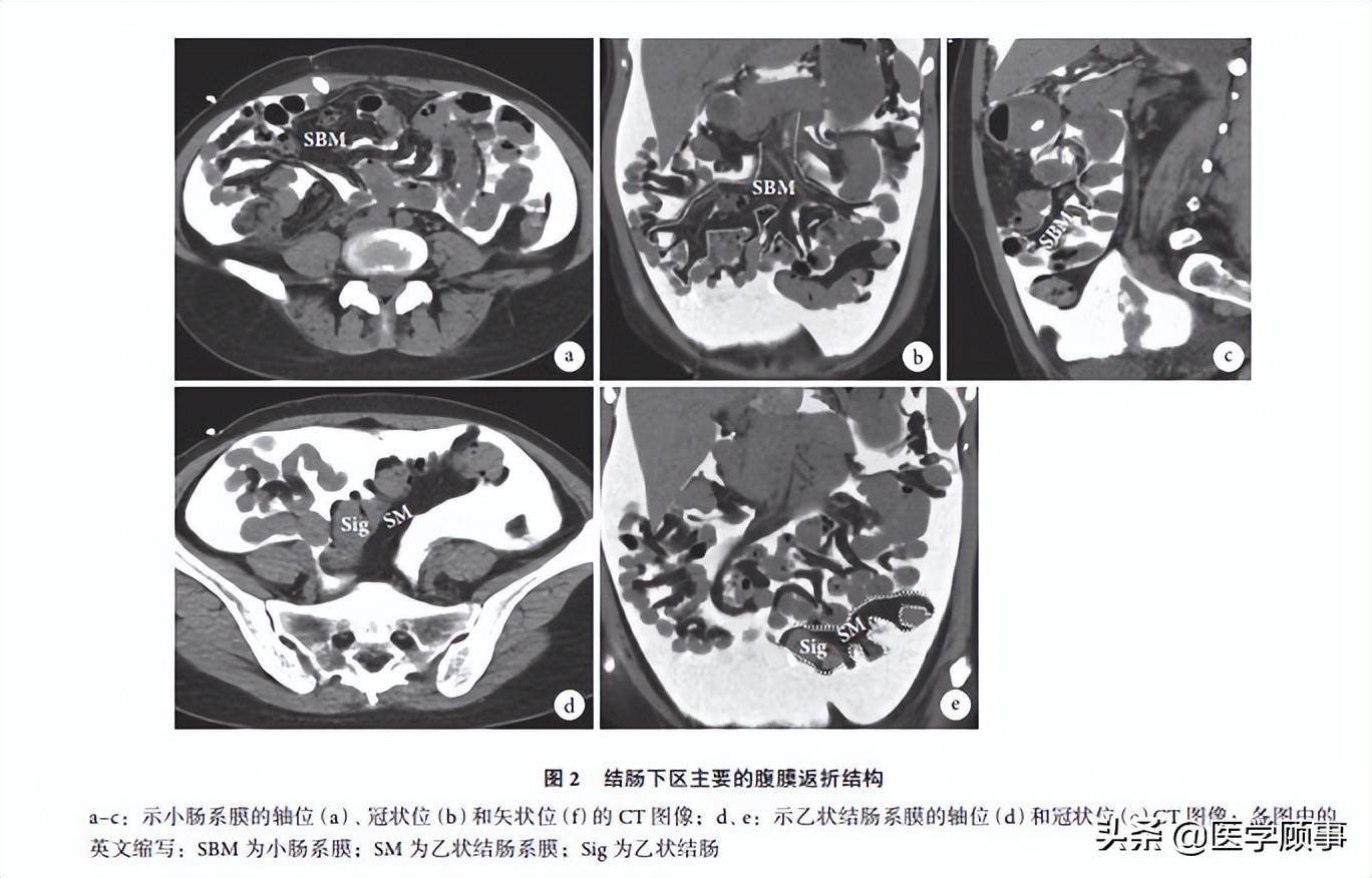 腹膜反折结构的影像解剖及疾病播散途径