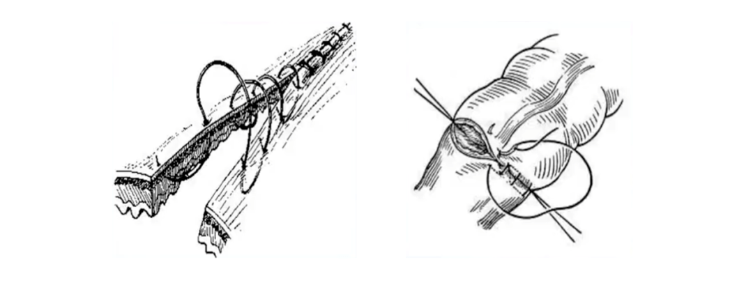 要點:開始第一針作腸壁全層單純縫合,即從一側漿膜面進針穿過全層,再