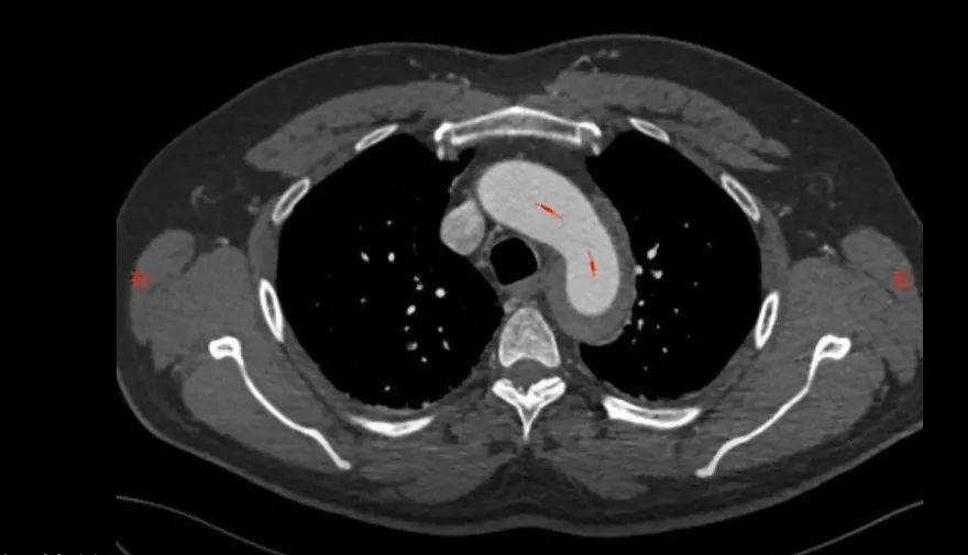 患者李坤(化名),53岁,因"胸痛17小时"来院就诊,入院后检查主动脉cta