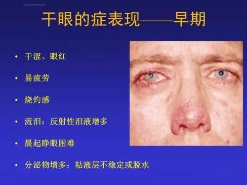 如何远离干眼症?