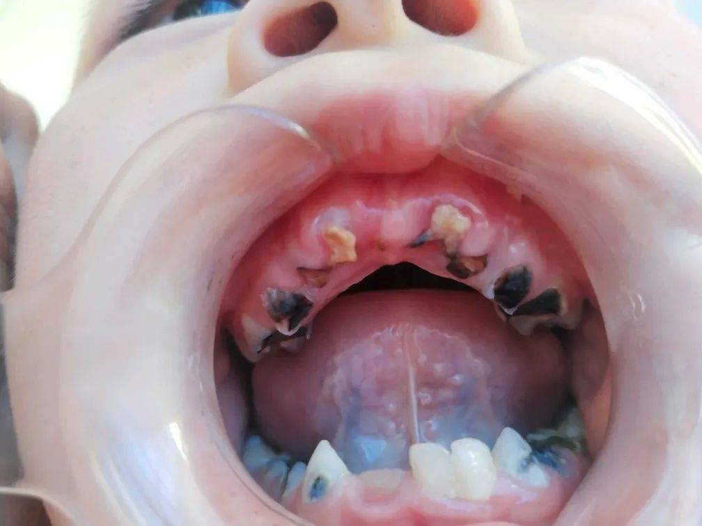 7岁男孩满嘴蛀牙:宝妈崩溃了,一个习惯引发龋齿