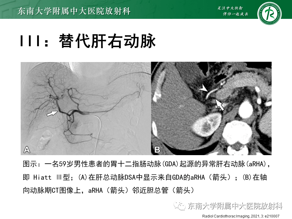 肝動脈變異---副右肝動脈_解剖圖_全網_影像