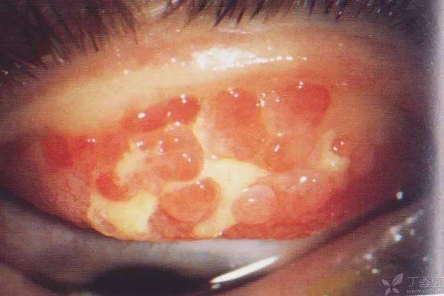 球结膜增生图片图片