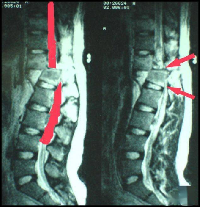 骨科病人护理翻身技巧 基础必备 患者 脊柱 损伤