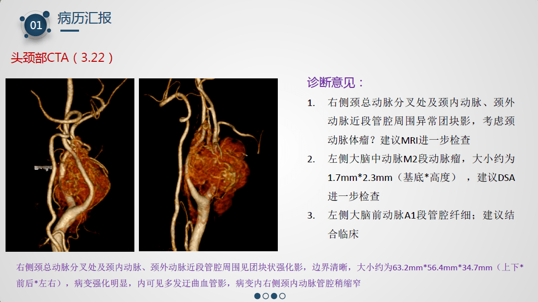 今晚直播icaa郑大中心医院第十七期颈动脉体瘤切除术患者的麻醉管理