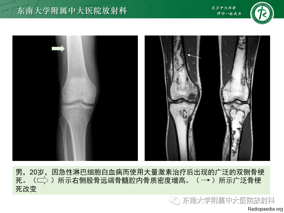 骨梗死影像表現_解剖圖_全網_膝關節