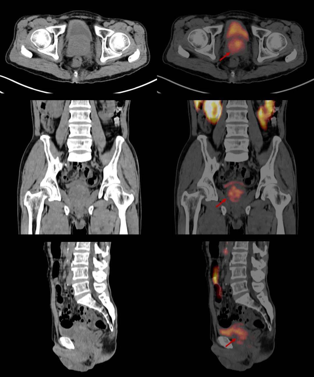 病例多发性骨髓瘤0160fpsmapetct显像一例