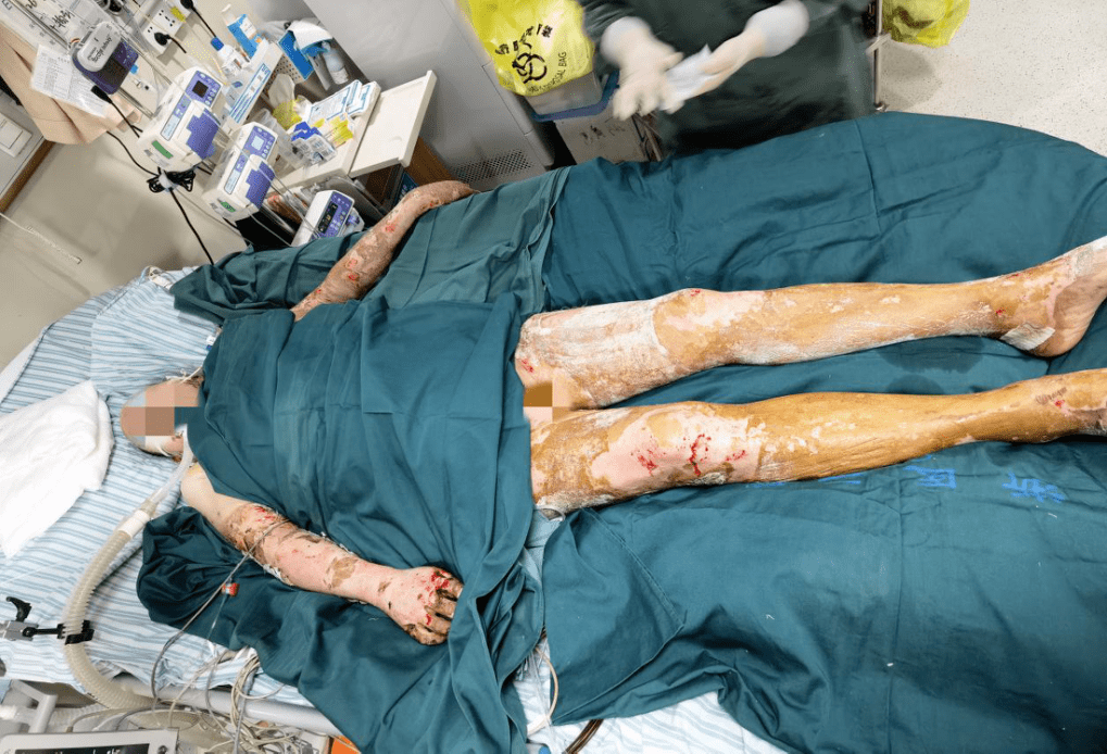 凌晨煤气爆炸急诊送来一个特重度烧伤的老年患者