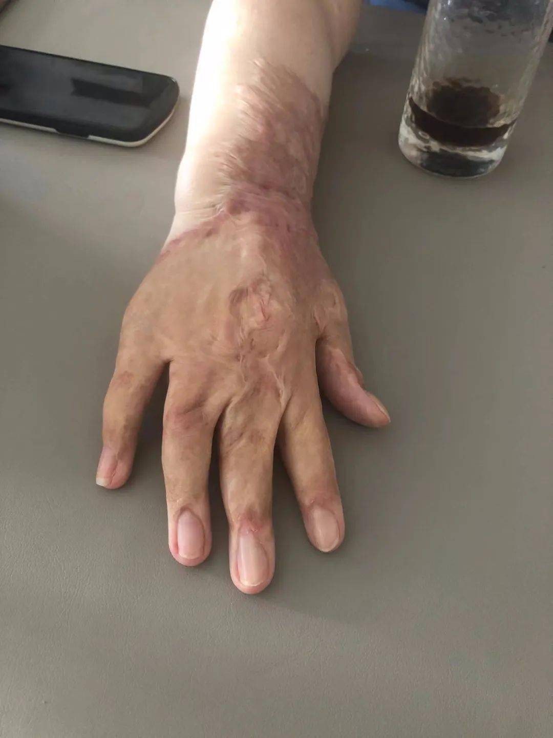 一个女孩被追求者毁容后的11年