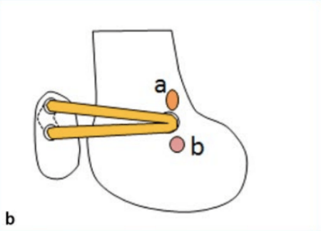 超详细讲解髌骨脱位的诊治全过程轻松搞定临床难题