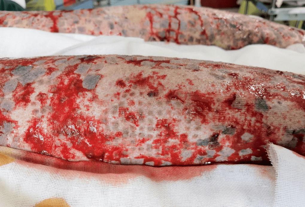 移植的 meek 皮片(密集黑点)和方块状的邮票状皮片)均存活良好并连片