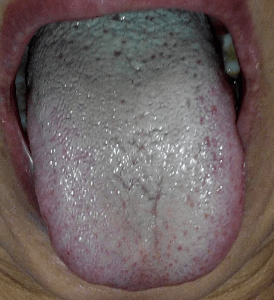 我们该如何根据舌苔分析身体的健康状态 舌头 时候 乳头