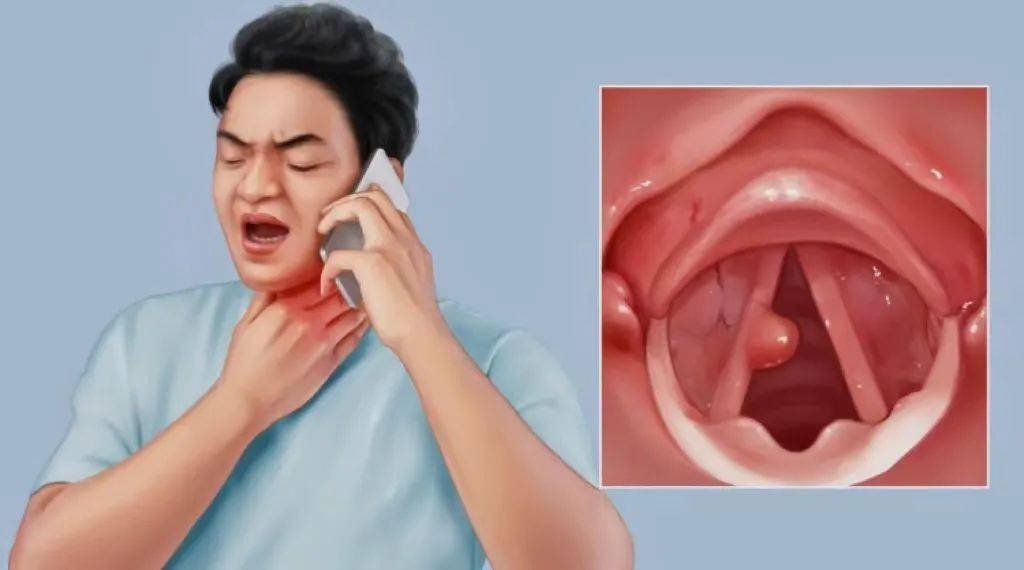喉咙有异物感怎么回事图片