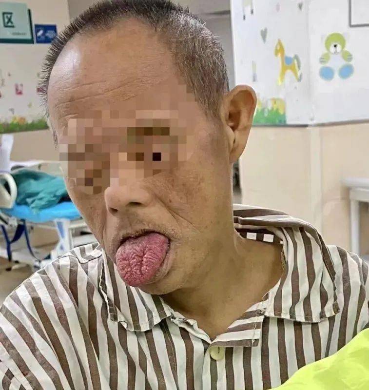 该名52岁唐氏综合征患者仅3岁左右智力,具有张口度受限,舌体肥大,颈短