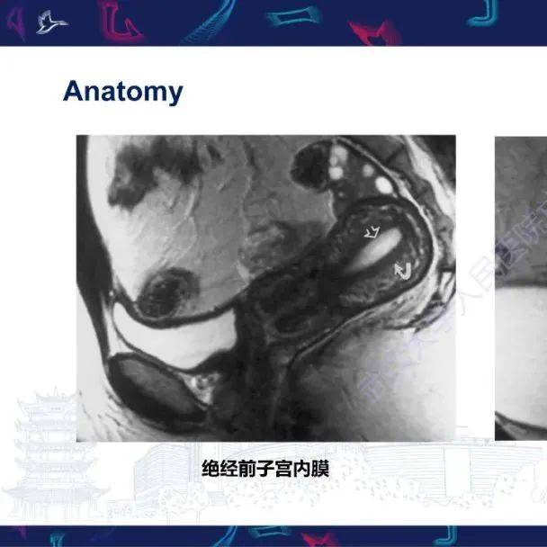 子宫内膜息肉样病变MRI诊断_影像_解剖图_全网