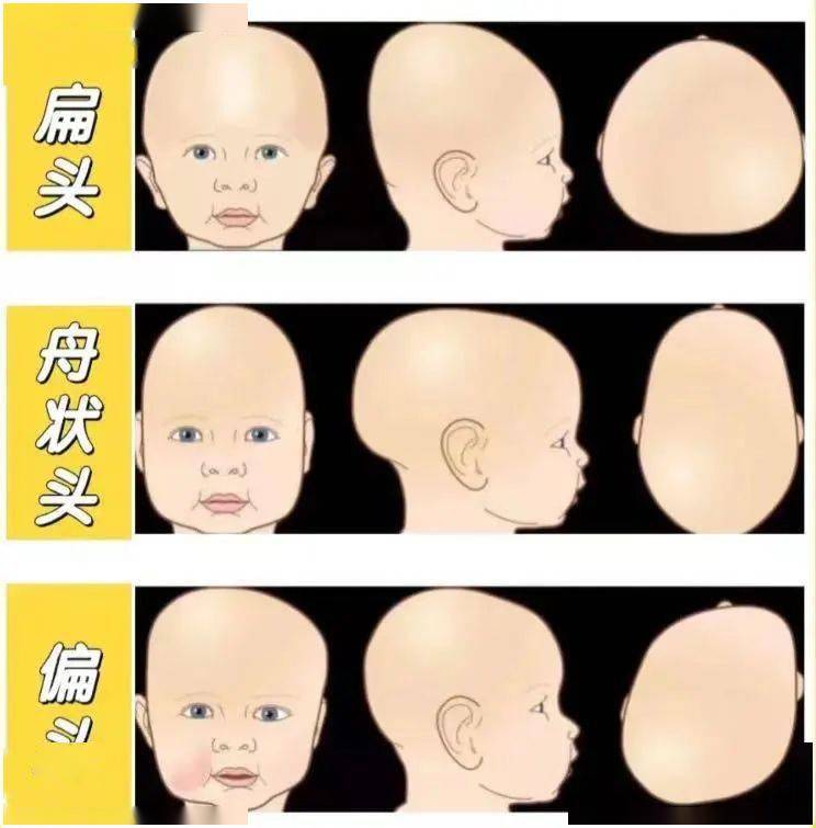 宝宝脑门窄头型像梨图片