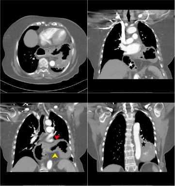 急性胃痛影像表现