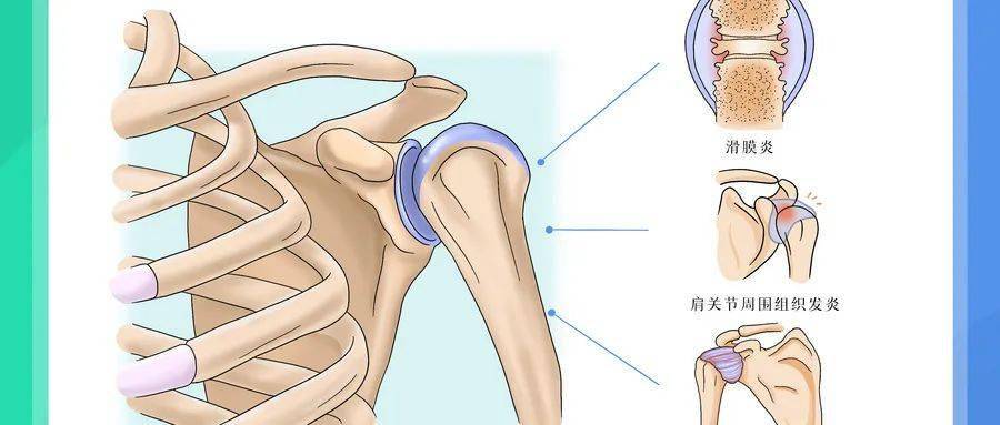 专家谈科普肩膀痛肩周炎关于肩周炎你了解多少