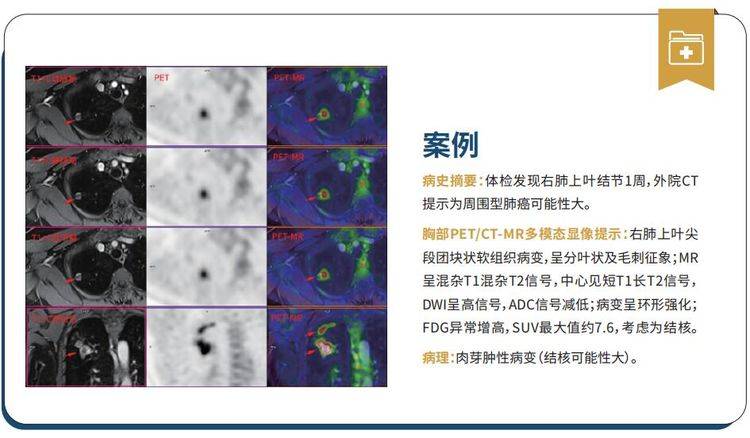 病例五pet/ct-mr多模態融合技術還可以應用在諸如腎透明細胞癌,小肝癌