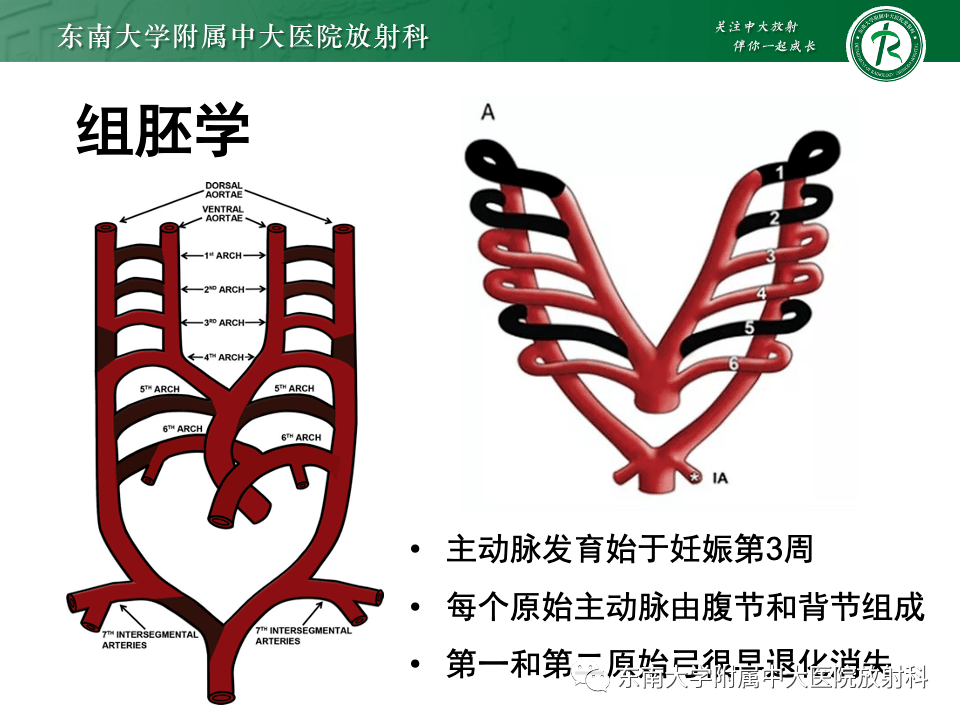 主动脉弓离断分型图片