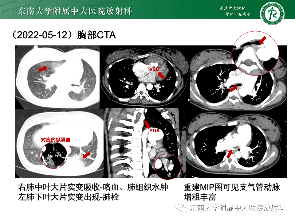 主動脈弓離斷_解剖圖_全網_影像