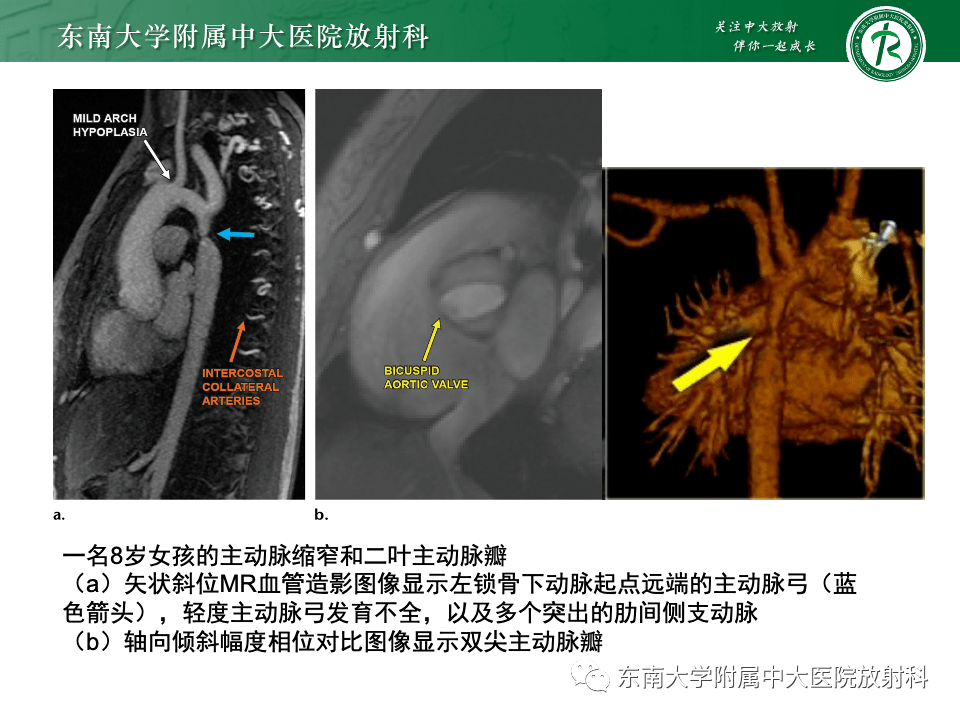 主動脈弓離斷