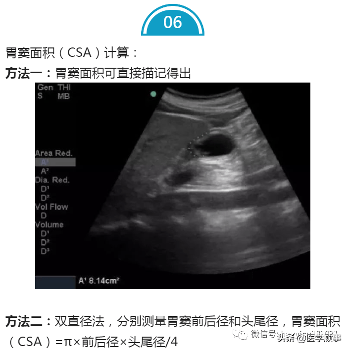 重症超声床边获得胃窦超声切面