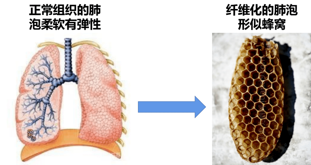 肺纤维化图片解剖图图片