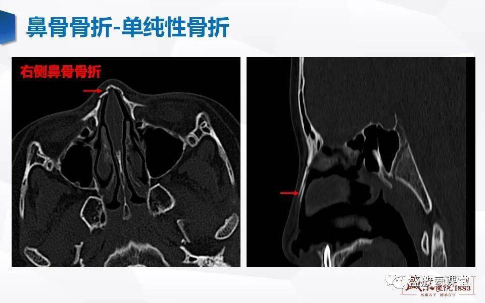 鼻骨断层解剖图片