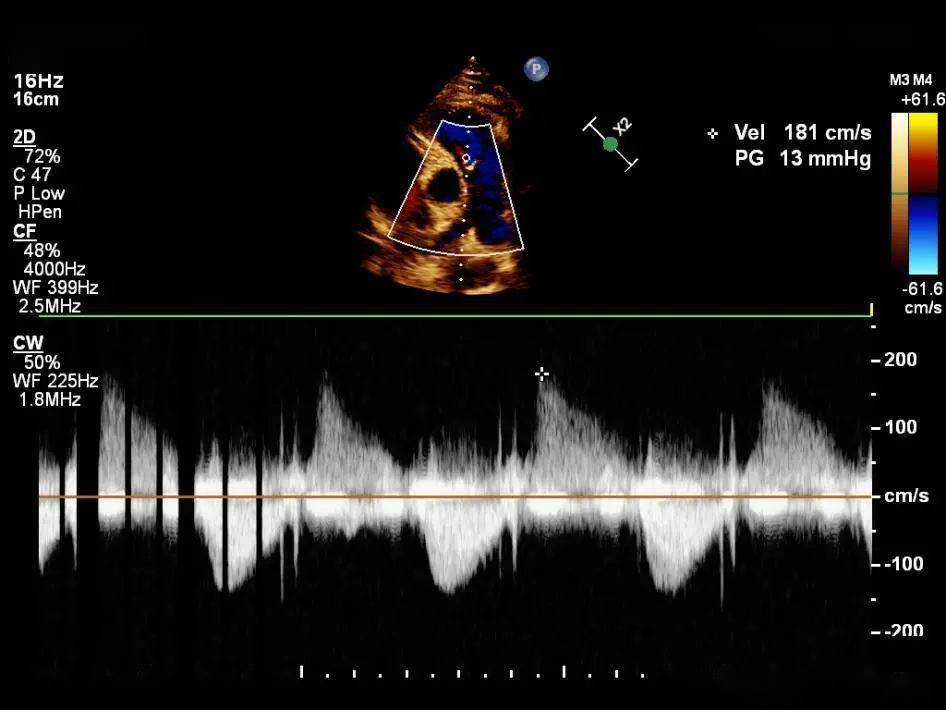 室间隔缺损超声图解图片