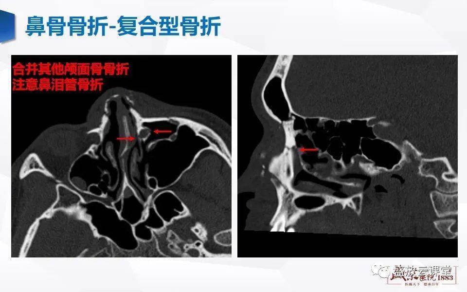 鼻骨正常ct解剖变异与骨折