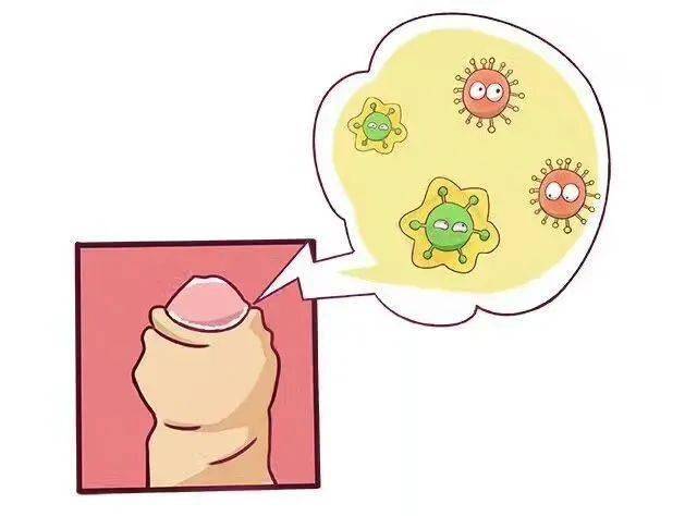 包皮过长易导致包皮与丁丁头经常发炎,长期炎症刺激会造成丁丁局部